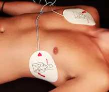 Male chest with defibrillator pads attached